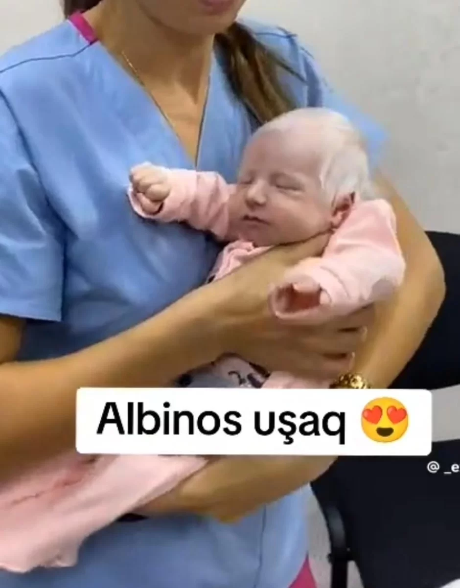 Azərbaycanda Albinos uşaq dünyaya gəlib